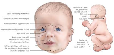 ข้อมูลเกี่ยวกับ Noonan Syndrome